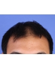 Before Hair Transplant &nbsp;2 Sessions (Areas)